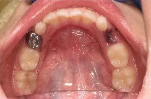 Лечение кариеса молочных зубов, покрытие коронкой 